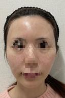 水光注射（ハリ・美肌） フィラークリニック 錦糸町院 AFTER サムネイル用