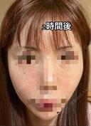 水光注射（ハリ・美肌） フィラークリニック 錦糸町院 DAY 0 サムネイル用