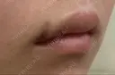 ヒアルロン酸注入（唇） / ボトックス（口角） ブルームクリニック（BLOOM CLINIC） DAY 2 サムネイル用
