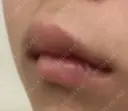 ヒアルロン酸注入（唇） / ボトックス（口角） ブルームクリニック（BLOOM CLINIC） DAY 2 サムネイル用
