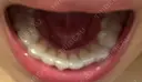 矯正（マウスピース） 目黒まついデンタルクリニック DAY 157 サムネイル用