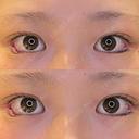 目尻切開 / タレ目形成・グラマラスライン（埋没） / 美容点滴・美容注射（美肌） LOUIS CLINIC 二子玉川院【ルイクリニック】 DAY 0 サムネイル用