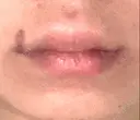 ヒアルロン酸注入（唇） / ボトックス（口角） ブルームクリニック（BLOOM CLINIC） AFTER サムネイル用