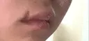 ヒアルロン酸注入（唇） / ボトックス（口角） ブルームクリニック（BLOOM CLINIC） DAY 3 サムネイル用