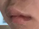 ヒアルロン酸注入（唇） / ボトックス（口角） ブルームクリニック（BLOOM CLINIC） DAY 3 サムネイル用
