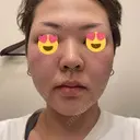 フラクショナルレーザー（毛穴・ニキビ跡） CLINICA BellaForma AFTER サムネイル用