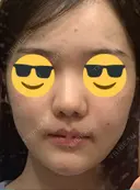 脂肪吸引注射（顔） イテウォンビューティークリニック 名古屋栄院 DAY 24 サムネイル用