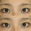 目尻切開 / タレ目形成・グラマラスライン（埋没） / 美容点滴・美容注射（美肌） LOUIS CLINIC 二子玉川院【ルイクリニック】 DAY 1 サムネイル用