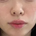 ヒアルロン酸注入（鼻翼基部） ルラ美容クリニック 渋谷本院 DAY 0 サムネイル用