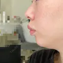 ヒアルロン酸注入（鼻翼基部） ルラ美容クリニック 渋谷本院 AFTER サムネイル用