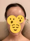 ハイフ（顔） リエンジャン整形外科 明洞店 DAY 4 サムネイル用