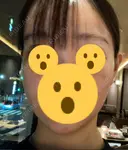 ハイフ（顔） リエンジャン整形外科 明洞店 DAY 2 サムネイル用