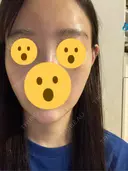 ハイフ（顔） リエンジャン整形外科 明洞店 DAY 3 サムネイル用