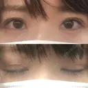 二重切開 / 目元修正 ルネッサンス美容外科医院 神戸院 DAY 66 サムネイル用