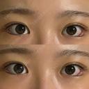 目尻切開 / タレ目形成・グラマラスライン（埋没） / 美容点滴・美容注射（美肌） LOUIS CLINIC 二子玉川院【ルイクリニック】 DAY 3 サムネイル用