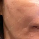 エレクトロポレーション / ピーリング（ハリ・ツヤ） LIFIX BEAUTY CLINIC AFTER サムネイル用