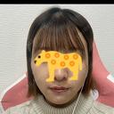 糸リフト / ヒアルロン酸注入（あご） / ボトックス（エラ・小顔） / 脂肪溶解注射（顔） 大阪TAクリニック DAY 14 サムネイル用