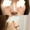 鼻尖形成（切開） / 小鼻縮小（切開） / 軟骨移植 / 鼻尖縮小 高崎美容クリニック DAY 232 サムネイル用