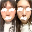 鼻尖形成（切開） / 小鼻縮小（切開） / 軟骨移植 / 鼻尖縮小 高崎美容クリニック DAY 232 サムネイル用