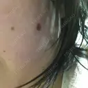 ほくろ・いぼ切除（肌） 甲府昭和形成外科クリニック DAY 2 サムネイル用