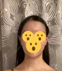 ハイフ（顔） リエンジャン整形外科 明洞店 DAY 7 サムネイル用