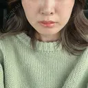 糸リフト / ヒアルロン酸注入（頬） EMMA CLINIC（エマクリニック） DAY 31 サムネイル用