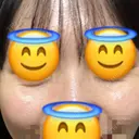 ヒアルロン酸注入（目の下） あじまビューティークリニック DAY 0 サムネイル用