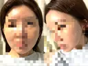 脂肪注入（額） GRACIA clinic 【グラシアクリニック】 DAY 8 サムネイル用