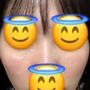 ヒアルロン酸注入（目の下） あじまビューティークリニック DAY 1 サムネイル用