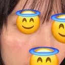 ヒアルロン酸注入（目の下） あじまビューティークリニック DAY 1 サムネイル用