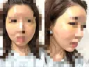 脂肪注入（額） GRACIA clinic 【グラシアクリニック】 DAY 9 サムネイル用