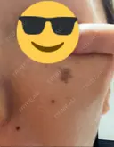 シミ取りレーザー 渋谷美容外科クリニック 横浜院 DAY 0 サムネイル用