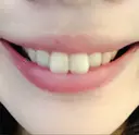 ガミースマイル手術 / その他（審美歯科/矯正歯科） / その他（口元） 有楽町美容外科クリニック AFTER サムネイル用