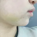 脂肪吸引（顔） ziz CLINIC AFTER サムネイル用