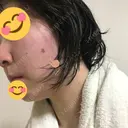 ほくろ・いぼ切除（肌） 甲府昭和形成外科クリニック DAY 3 サムネイル用