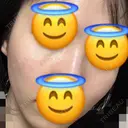 ヒアルロン酸注入（目の下） あじまビューティークリニック DAY 2 サムネイル用