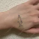タトゥー除去 ziz CLINIC DAY 4 サムネイル用