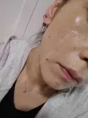 糸リフト / ヒアルロン酸注入（頬） ネビュラクリニック 広島院 DAY 21 サムネイル用