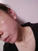 糸リフト / ヒアルロン酸注入（頬） ネビュラクリニック 広島院 DAY 14 サムネイル用