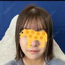 糸リフト / ヒアルロン酸注入（あご） / ボトックス（エラ・小顔） / 脂肪溶解注射（顔） 大阪TAクリニック DAY 24 サムネイル用