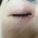 ニードルRF（ポテンツァなど） 表参道スキンクリニック 名古屋院（DAILY SKIN CLINIC提携院） DAY 0 サムネイル用