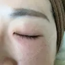 ニードルRF（ポテンツァなど） 表参道スキンクリニック 名古屋院（DAILY SKIN CLINIC提携院） DAY 0 サムネイル用