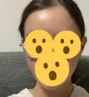 ハイフ（顔） リエンジャン整形外科 明洞店 AFTER サムネイル用