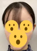 ハイフ（顔） リエンジャン整形外科 明洞店 DAY 9 サムネイル用