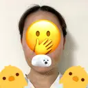 脂肪吸引（顔） 札幌ル・トロワ ビューティクリニックVogue DAY 14 サムネイル用