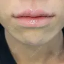 ヒアルロン酸注入（唇） / ボトックス（口角） / その他（輪郭） ルラ美容クリニック 渋谷本院 AFTER サムネイル用