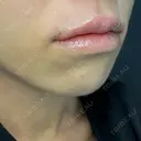 ヒアルロン酸注入（唇） / ボトックス（口角） / その他（輪郭） ルラ美容クリニック 渋谷本院 DAY 0 サムネイル用