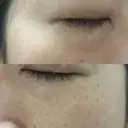 ニードルRF（ポテンツァなど） 表参道スキンクリニック 名古屋院（DAILY SKIN CLINIC提携院） DAY 1 サムネイル用