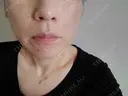 糸リフト / ヒアルロン酸注入（頬） ネビュラクリニック 広島院 AFTER サムネイル用