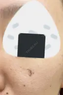 シミ取りレーザー 渋谷美容外科クリニック 横浜院 DAY 7 サムネイル用